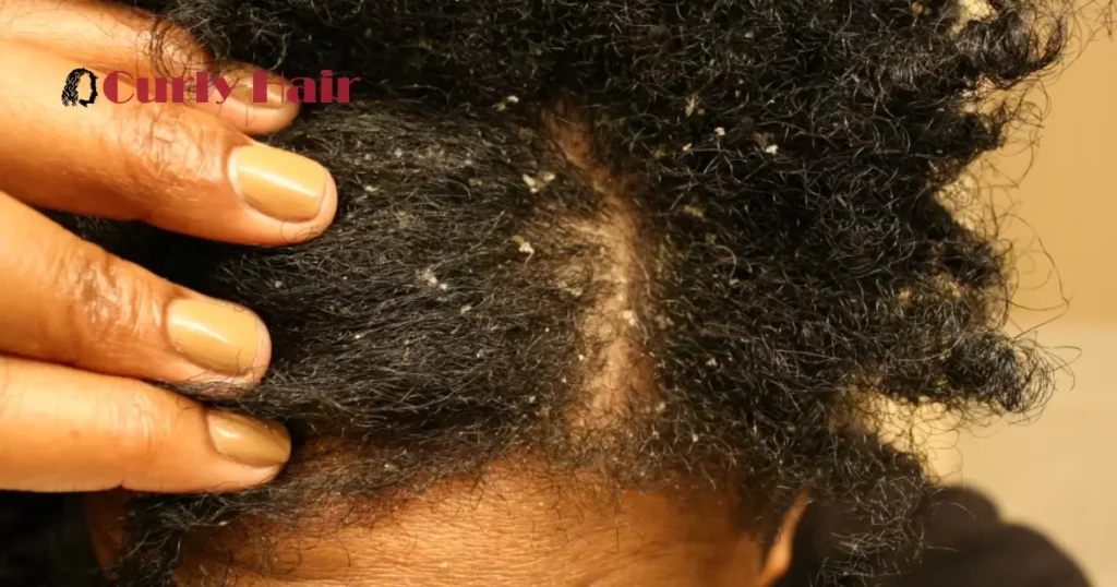 4 Common Scalp Issues For Black Hair