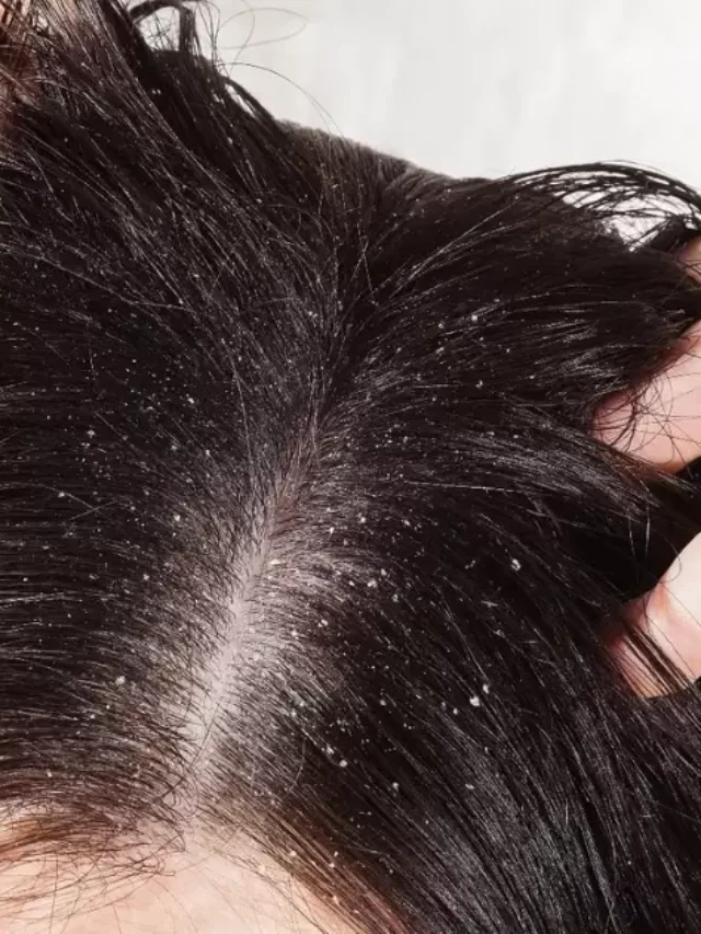 Dandruff Vs Dry Scalp Black Hair