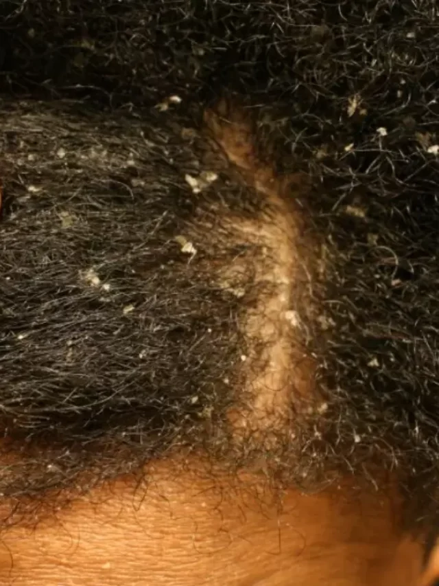 How To Treat Dry Scalp And Dandruff For Curly Hair?