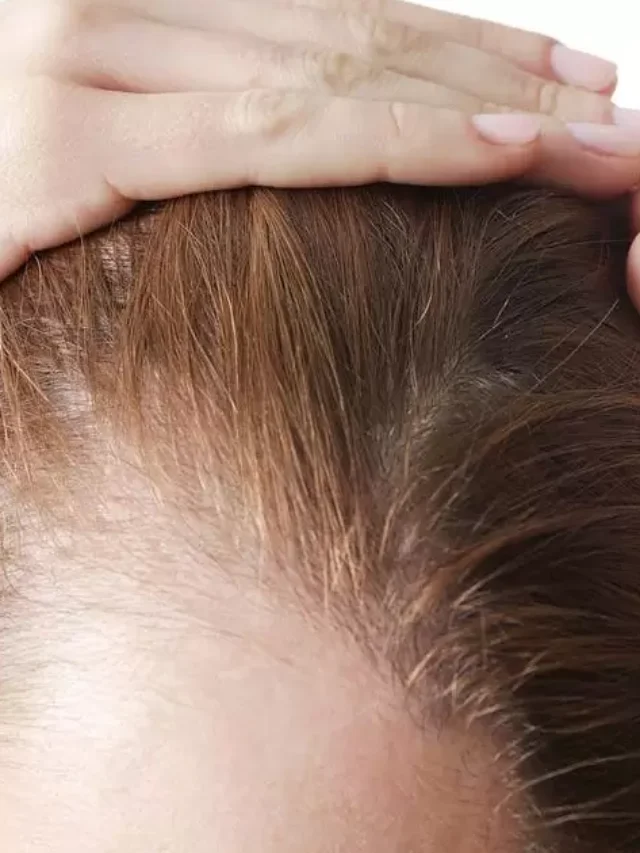 Oily Scalp Thinning Hair