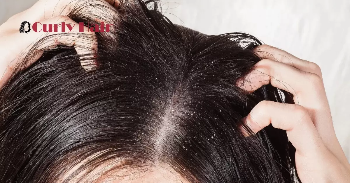 Dandruff Vs Dry Scalp Black Hair