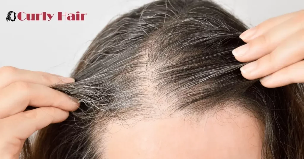Oily Scalp Alongside Hair Loss