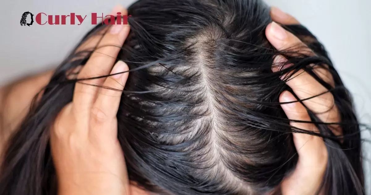Oily Scalp Hair Loss Reversible